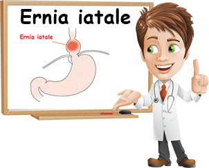 Ernia iatale