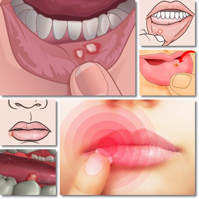 bocca ulcera